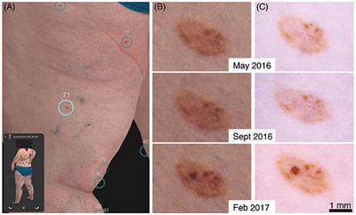 Clinical Perspective of 3D Total Body Photography for Early Detection and Screening of Melanoma